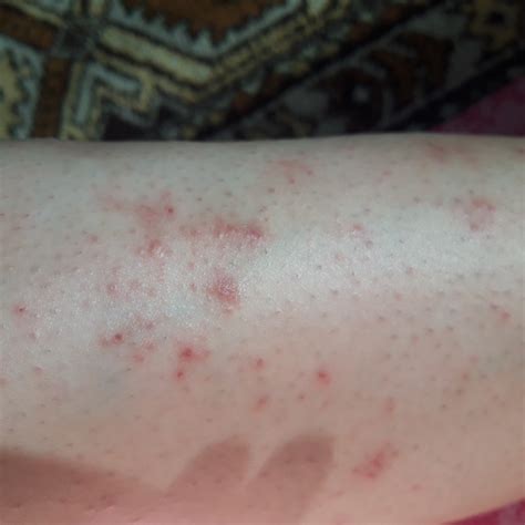Аллергия как один из факторов появления проблем на коже ног и сыпи
