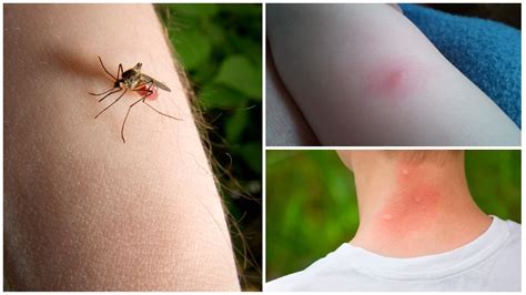 Альтернативные способы уменьшения отека после укуса комара