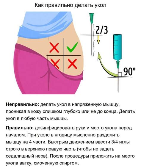 Безопасные шаги для введения препаратов в ягодицу пациента