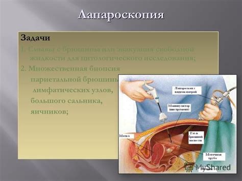 Биопсия яичников - инвазивный метод для получения точных данных о резервах яйцеклеток