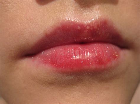 Борьба с главными причинами проблем на губах