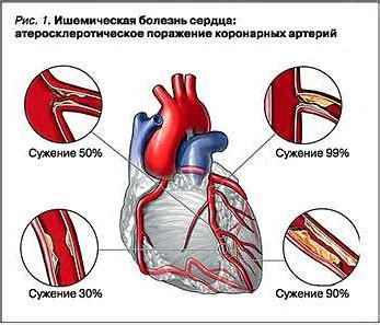 Важное значение правильного питания в профилактике и лечении ишемической болезни сердца