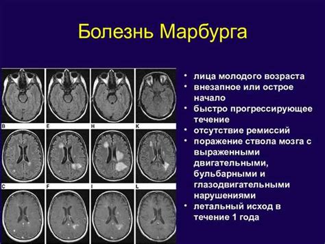 Влияние генетических факторов и возможные причины развития синдрома. Основные симптомы и их возможные последствия для зрительной функции.