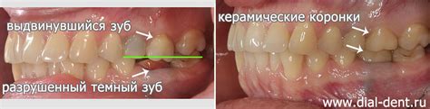 Влияние отсутствия двух зубов жевательных на организм