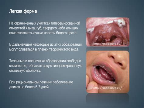 Влияние питания на появление и лечение афтозных явлений в полости рта