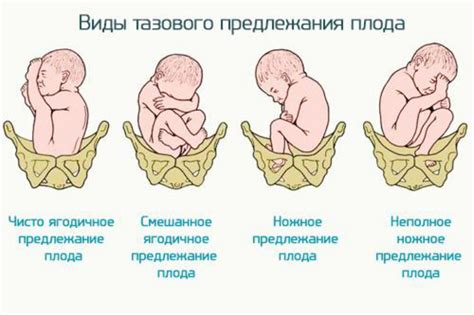 Влияние положения плода на ход родового процесса