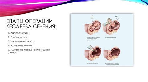 Внешние характеристики пола операции Кесарева сечения: что следует учитывать?