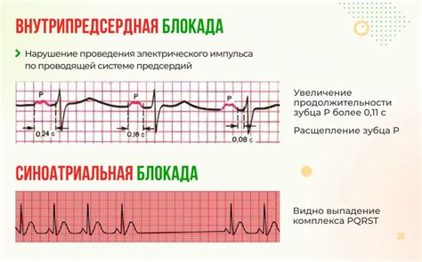 Внутрипредсердная блокада 1 степени: основные черты