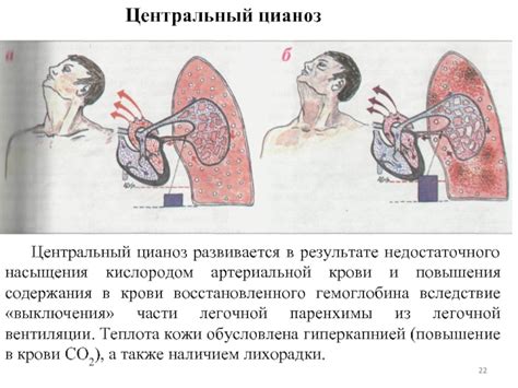 Воздействие недостаточного насыщения кислородом при пневмонии