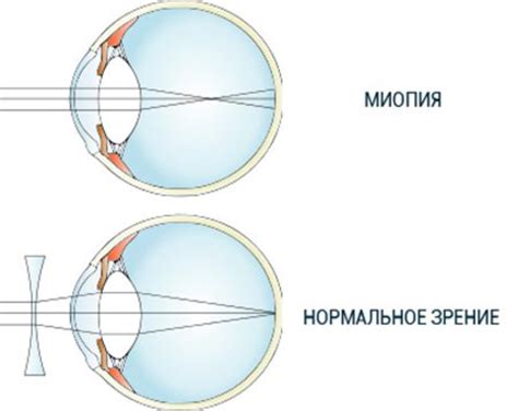 Возможные долгосрочные проблемы со зрением