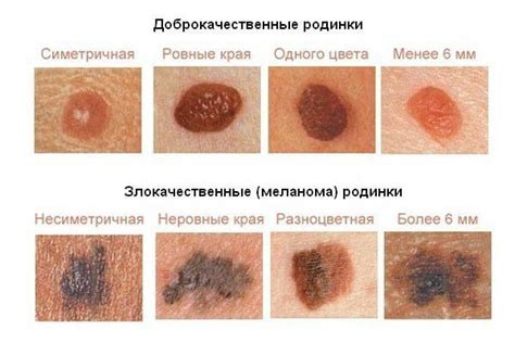 Возможные заболевания и изменения в организме, обусловливающие появление родинок