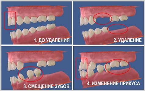 Возможные последствия отсутствия зубов