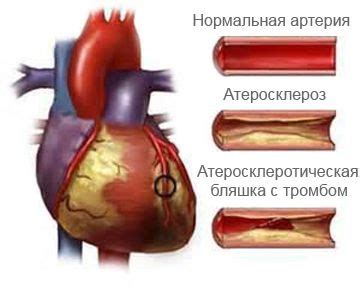 Возможные причины нестабильной стенокардии