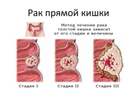 Воспаление слизистой оболочки прямой кишки: причины и симптомы