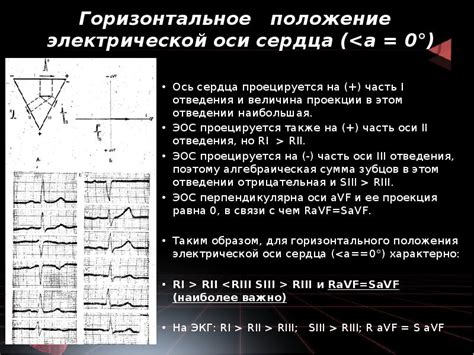 Горизонтальное положение электрокардиографической оси: ключевой показатель в анализе состояния сердца