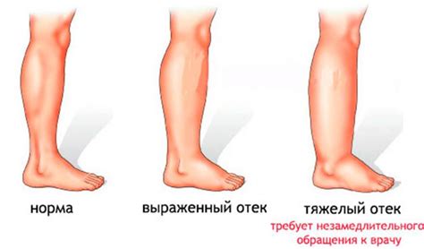 Гормональный дисбаланс и отеки ног