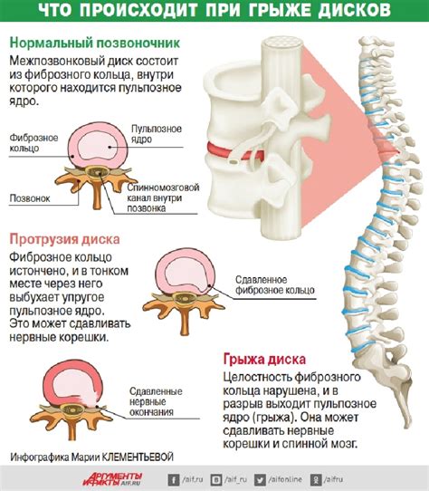 Диагностика грыжи в нижнем отделе позвоночника: ключевые этапы и методы