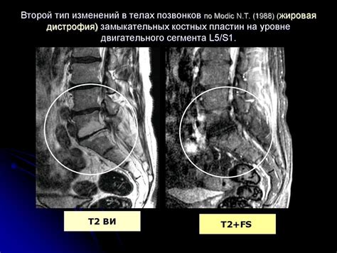 Диагностика дефекта шморля в нижней части спины: выявление и оценка