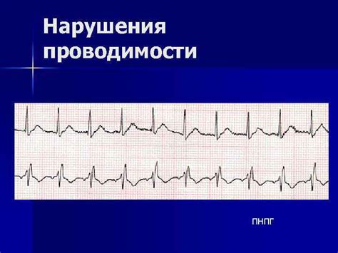 Диагностика нарушения проводимости по ПНПГ