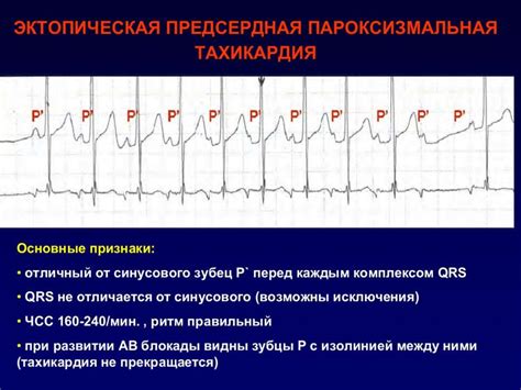 Диагностика нерегулярного ритма сердца