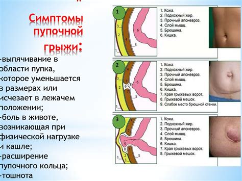 Загноившийся пупок: причины и симптомы