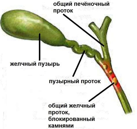 Закупорка желчных протоков