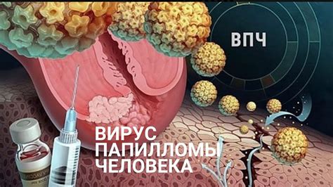 Защита от вируса папилломы: роль вакцинации в предотвращении заболевания