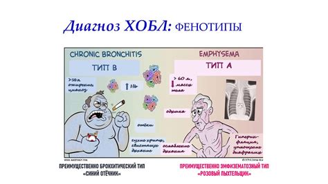 Значимость корректной диагностики хобл