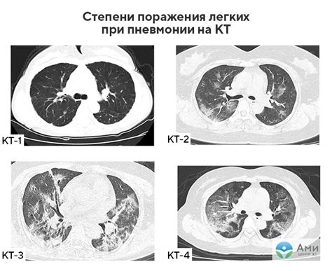 Излучение после КТ легких: что нужно знать