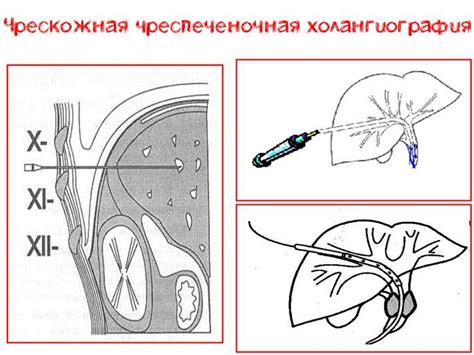 Интраоперационная холангиография: сущность процедуры и ее особенности