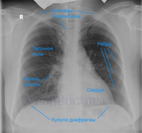 Какие признаки указывают на наличие расшатанности в обоих полостях грудной клетки