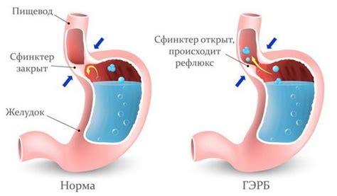 Как определить присутствие спазмов в желудке и факторы, вызывающие их?