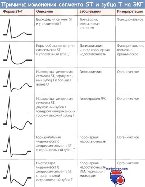 Как разбирать и анализировать отдельные патологические сокращения на электрокардиограмме?