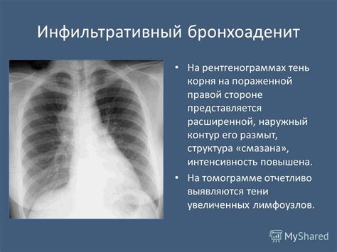 Как различить фокусную тень от других заболеваний на рентгенограммах?