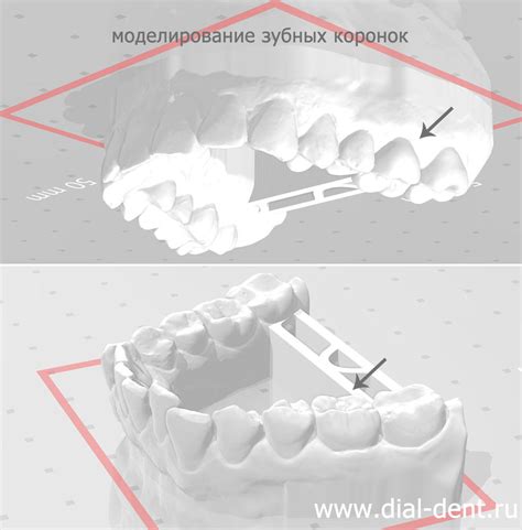 Как решить проблему отсутствия двух зубов жевательных?