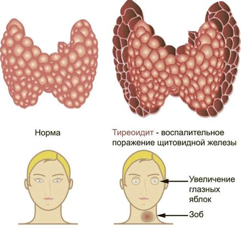 Как справиться с снижением уровня гормона щитовидной железы?