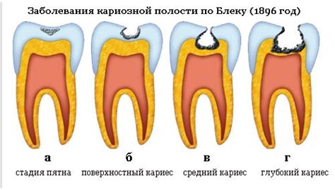 Кариес и зубные пульпиты