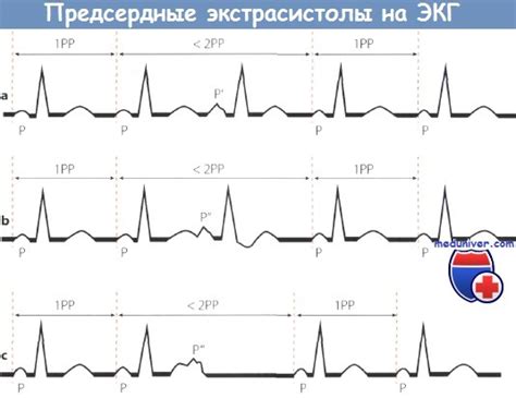 Клинические проявления парной предсердной экстрасистолии: симптоматика и проявление синдромов