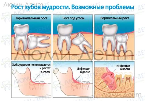 Комплексы корней зуба мудрости