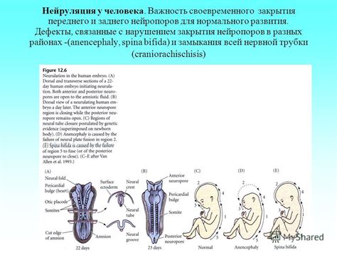 Компликации и проблемы, связанные с отклонением от нормального развития сосудистого круга Мишеля виллиса