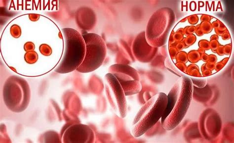 Лечение анемии: современные методы восстановления недостающих элементов организма