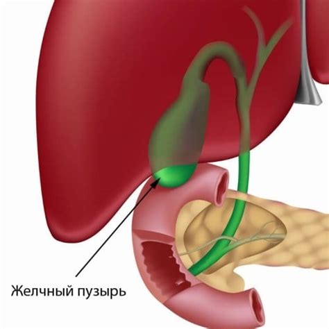 Лечение и эффекты дисфункции желчного пузыря с образованием осадка