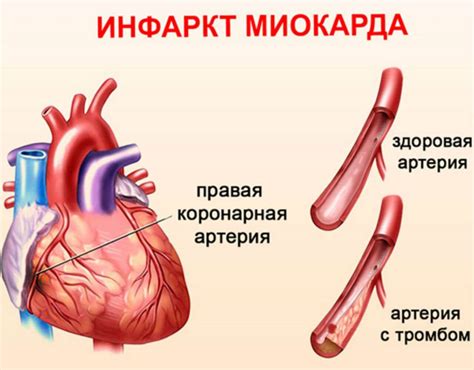 Лечение нетрансмурального инфаркта миокарда