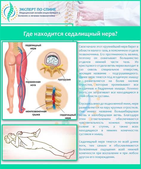 Мануальная релокация седалищного нерва: возвращение к оптимальной позиции