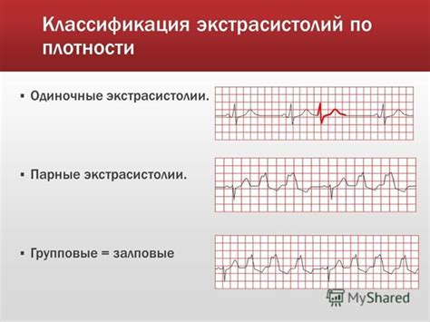 Медикаментозное лечение парной экстрасистолии: основные подходы и применяемые препараты