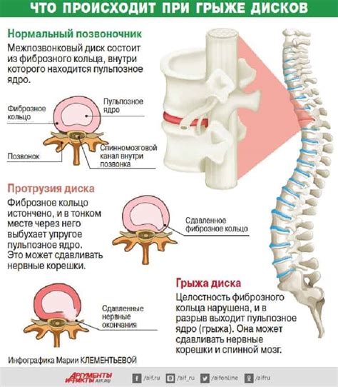 Методы диагностики пролапсов межпозвоночных дисков