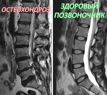 Методы обнаружения и определения наличия узлов в межпозвоночных дисках поясничного отдела