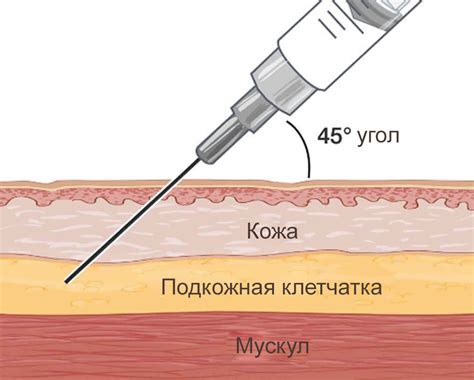 Метод инъекции для эффективного удаления Эспераля