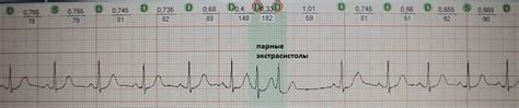 Механизмы парной предсердной экстрасистолии: что происходит в организме