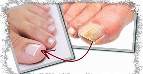 Множество способов устранения утолщения ногтя и их эффективность